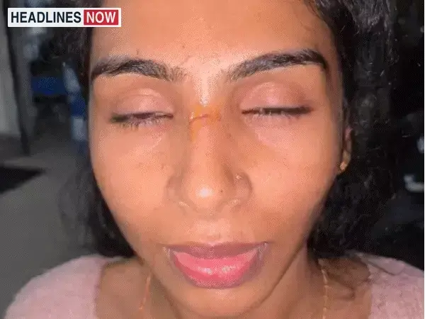 चाइनीज मांझे से हेलमेट के अंदर कटी महिला की नाक:इटारसी में ऑर्डनेंस फैक्ट्री से लौट रही थी; कॉन्स्टेबल के माथे-कान पर 8 टांके